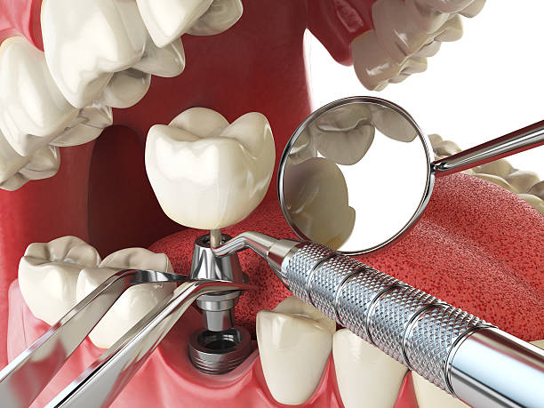 Best Knocked-Out Tooth Emergency  in North Manchester, IN